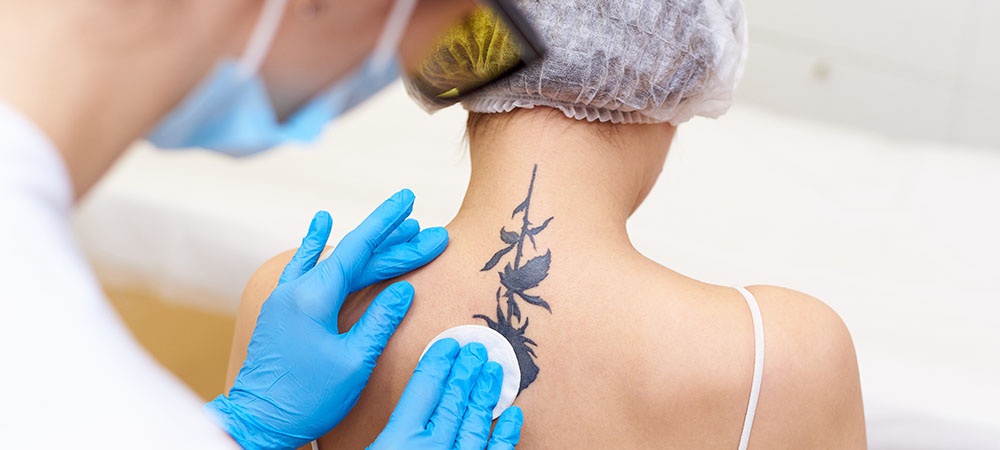 Best Tattoo Removal Treatments in Toronto | Fresha