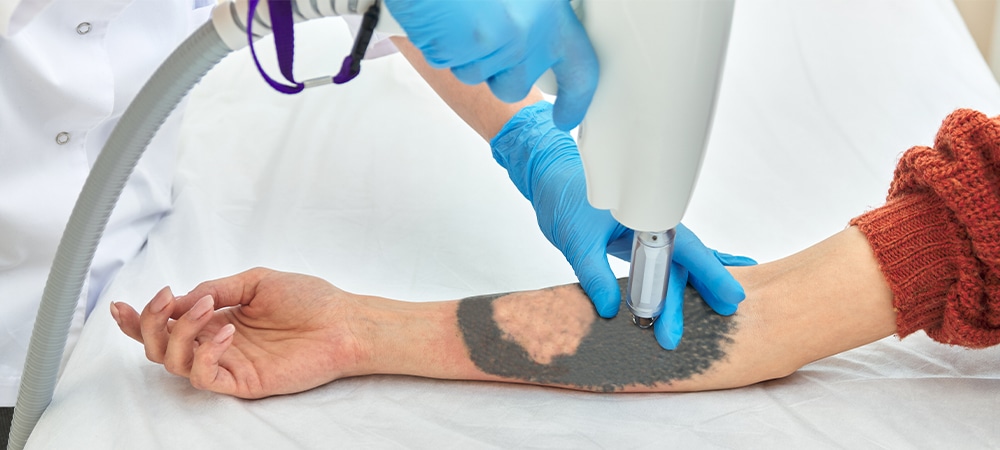 factors that influence tattoo removal cost