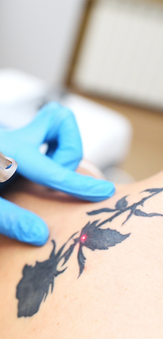 laser fading for tattoo coverup